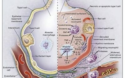 Bioxytran Guest Speaker Discussing Acute Respiratory Distress Syndrome and Ways to Combat COVID-19